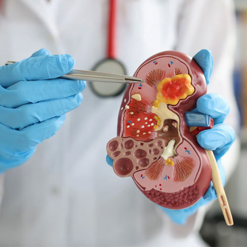 Kidney cancer